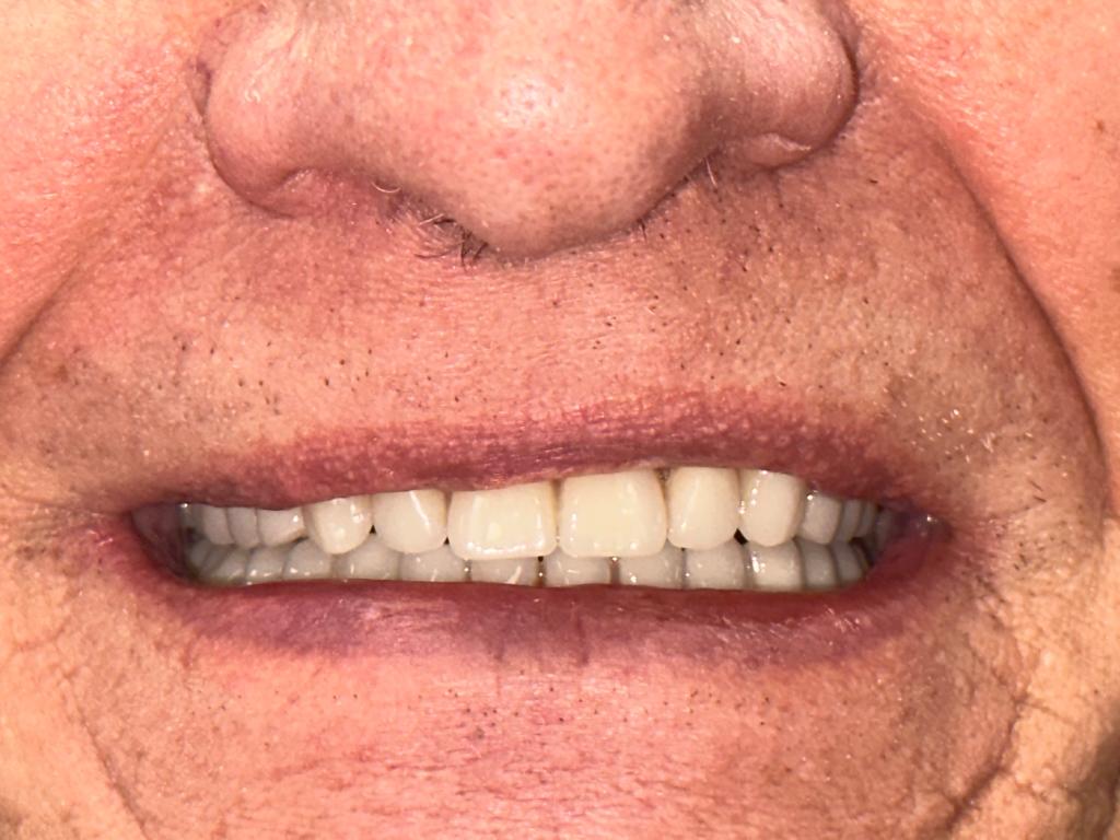 after all on 4 implants