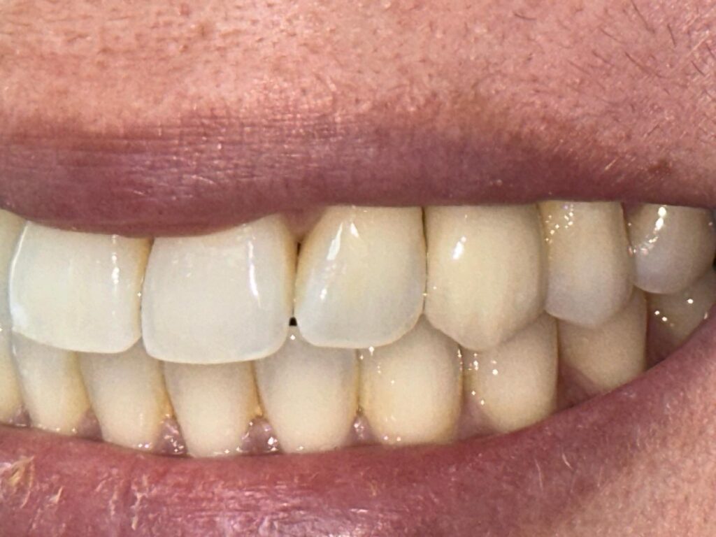 after single implant