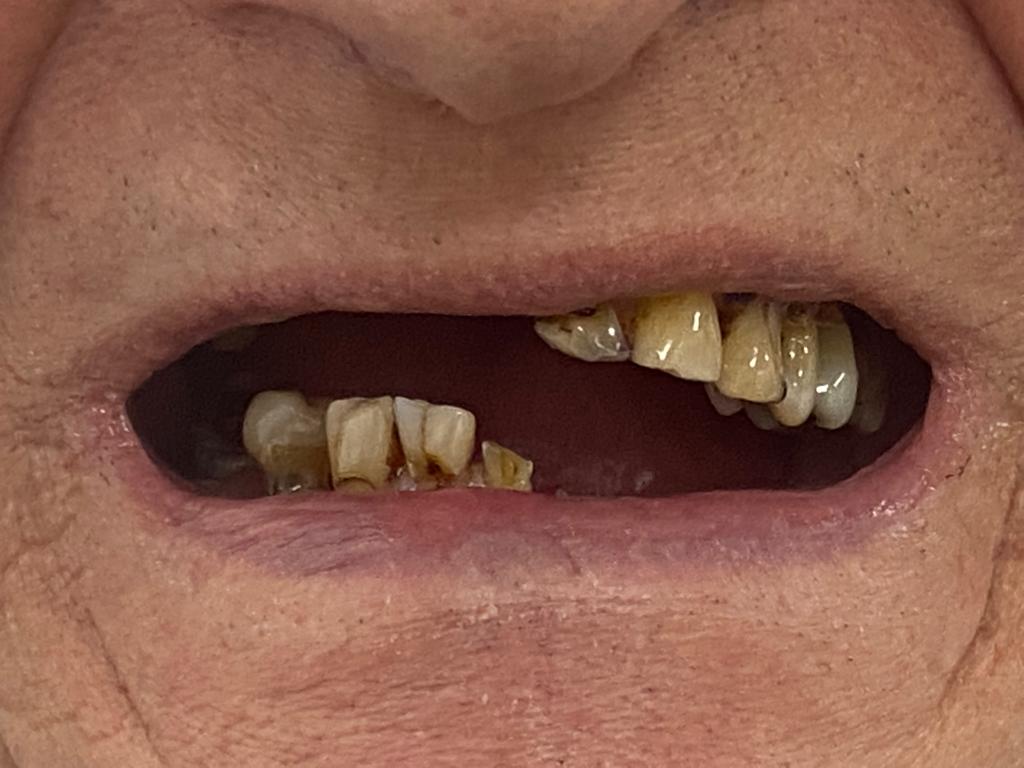 before all on 4 implants