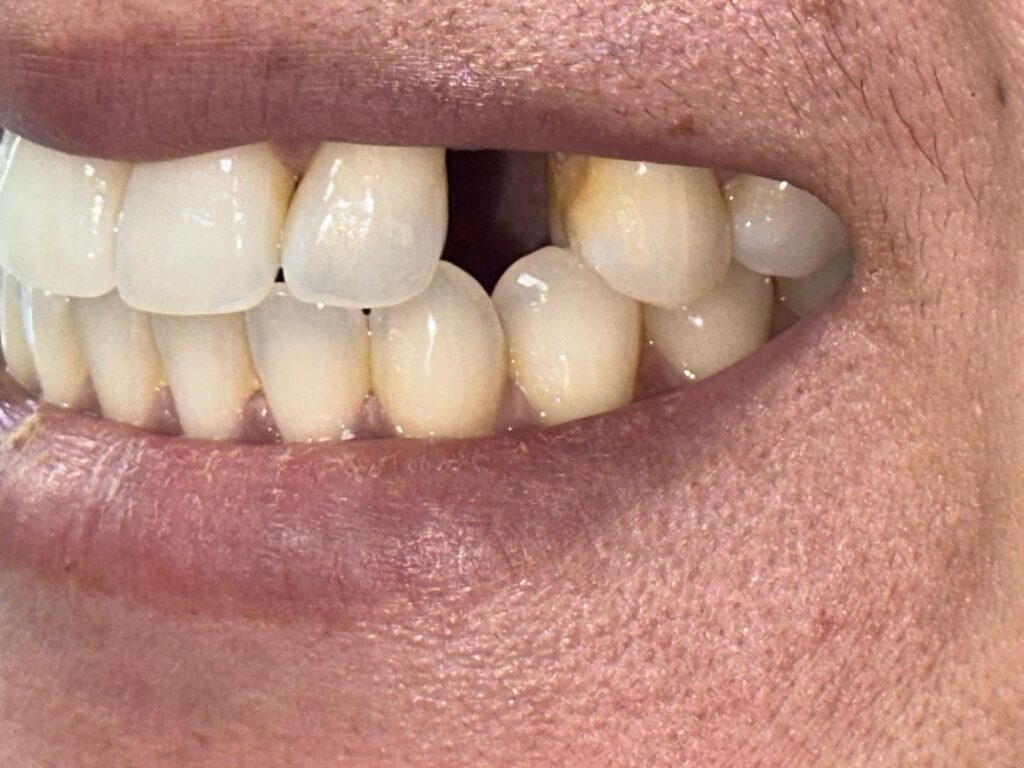 before single implant
