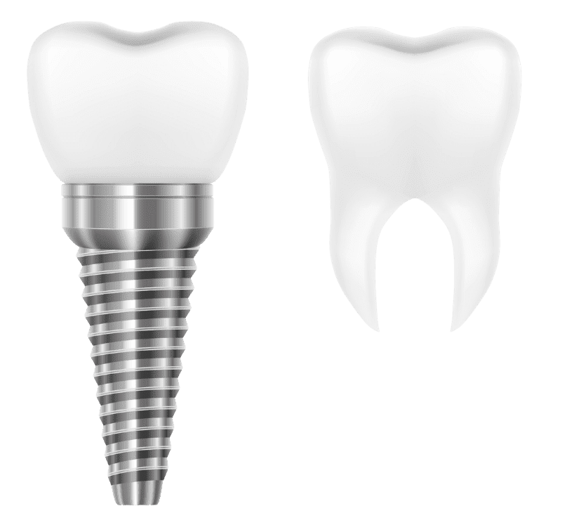 dental implant costs