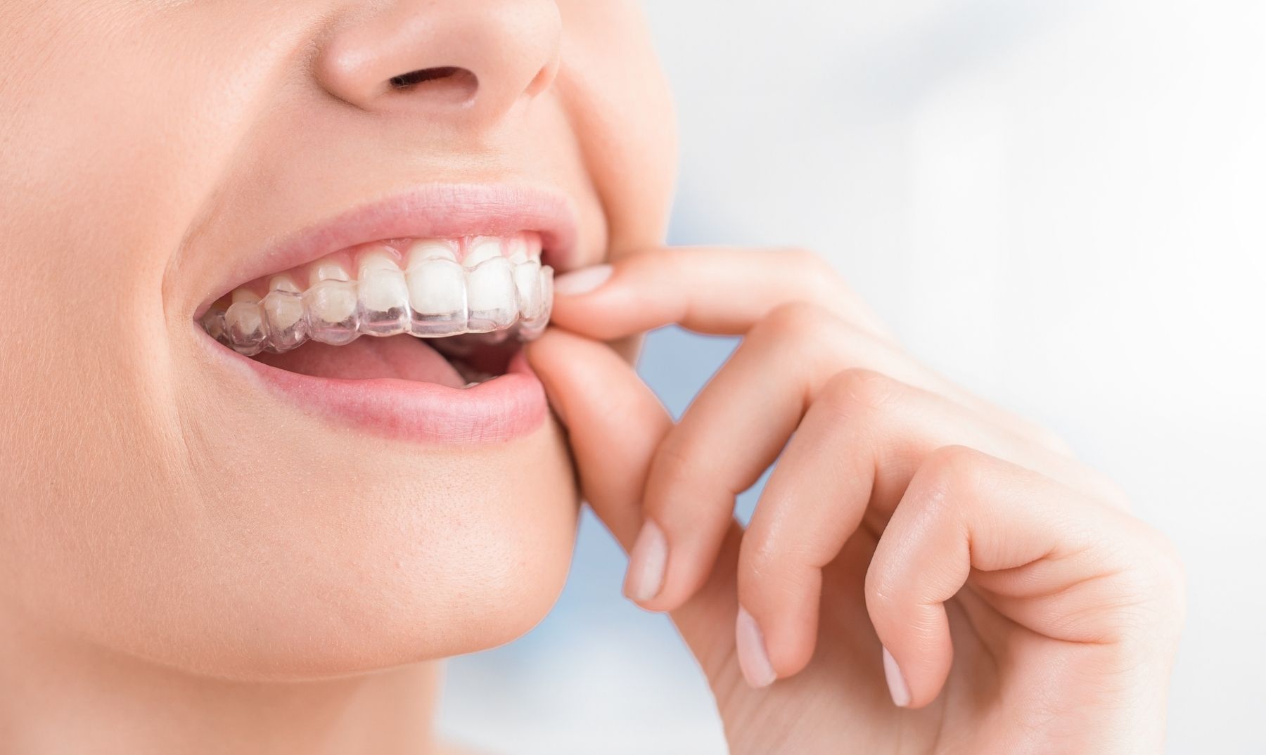 invisalign process