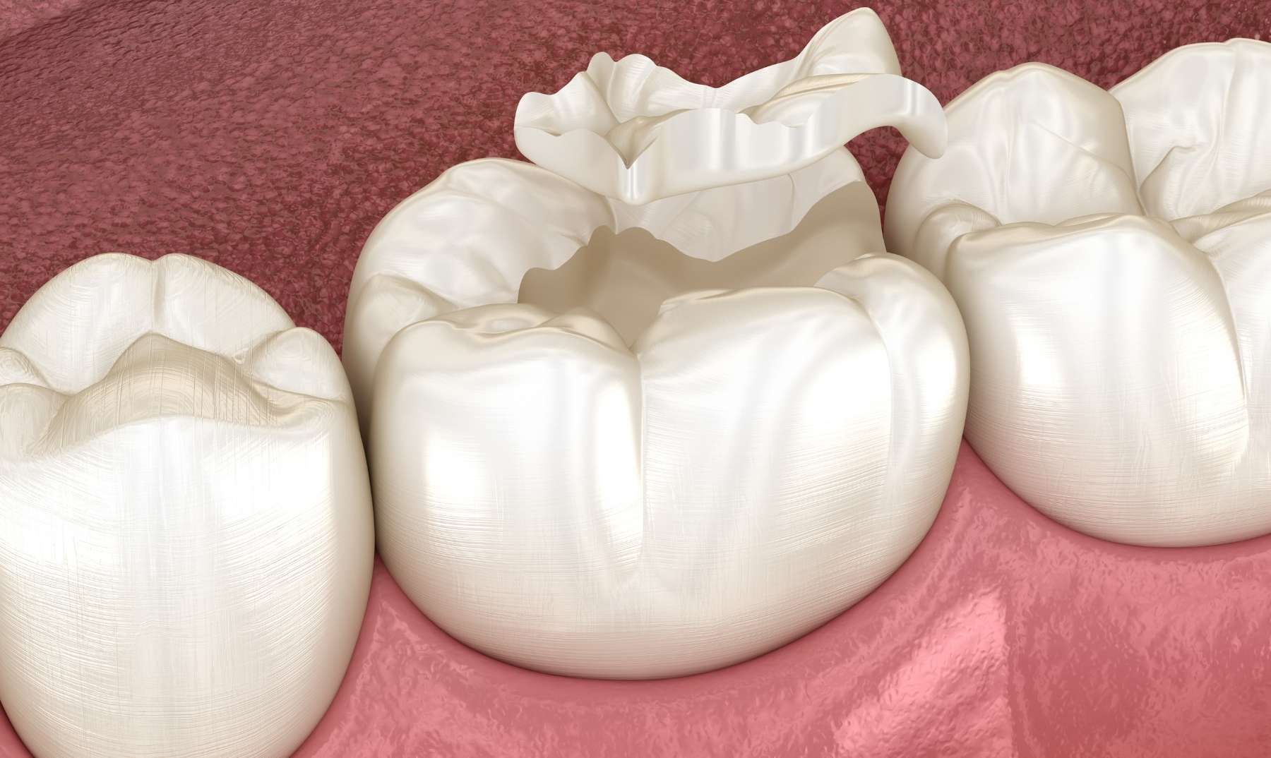 Cracked teeth
