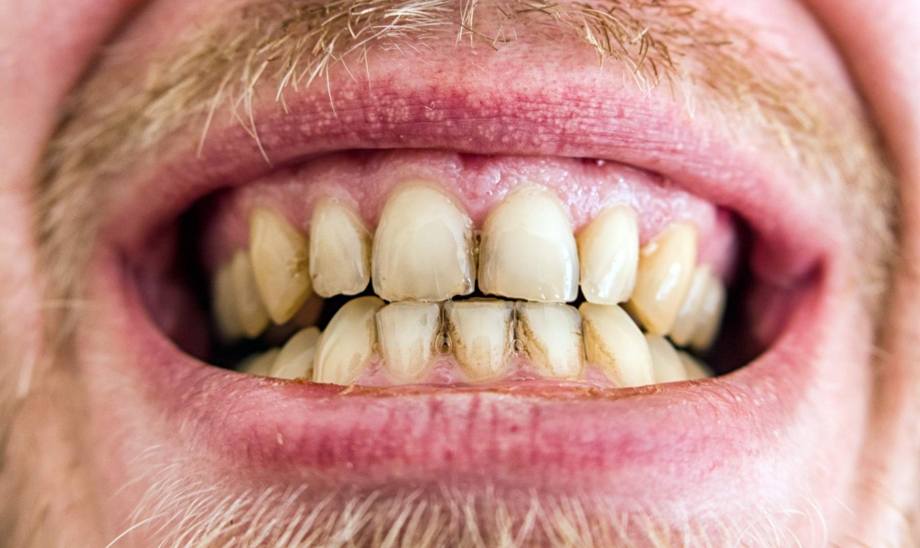 Yellow teeth