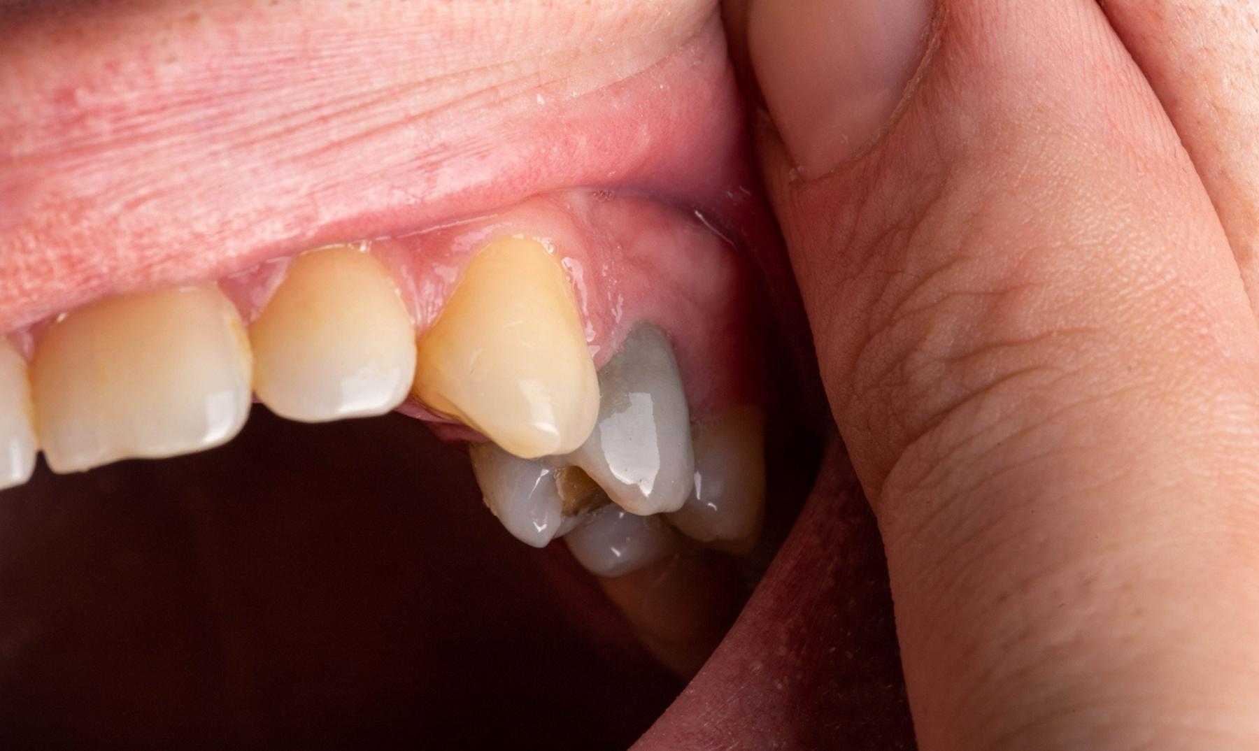 black tooth