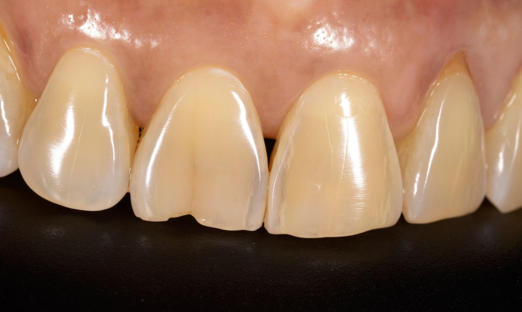 chipped tooth