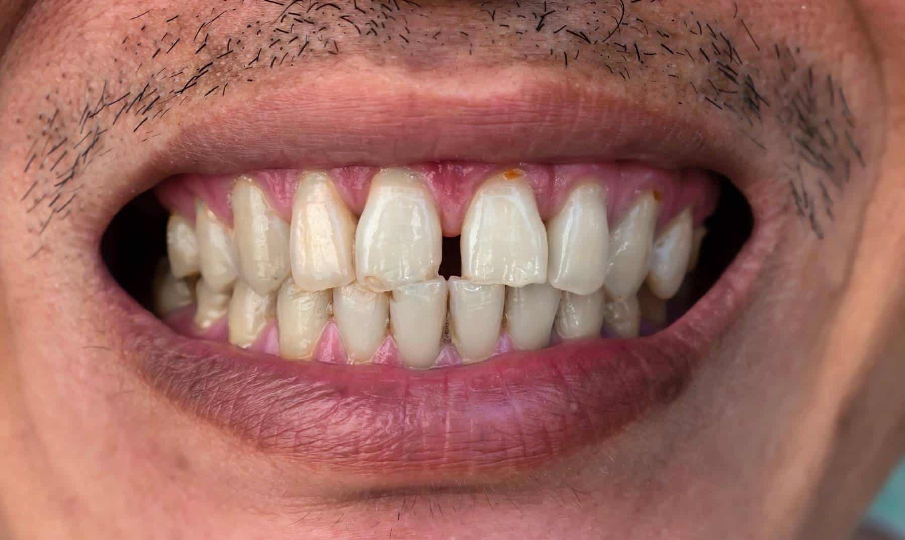 gapped-teeth