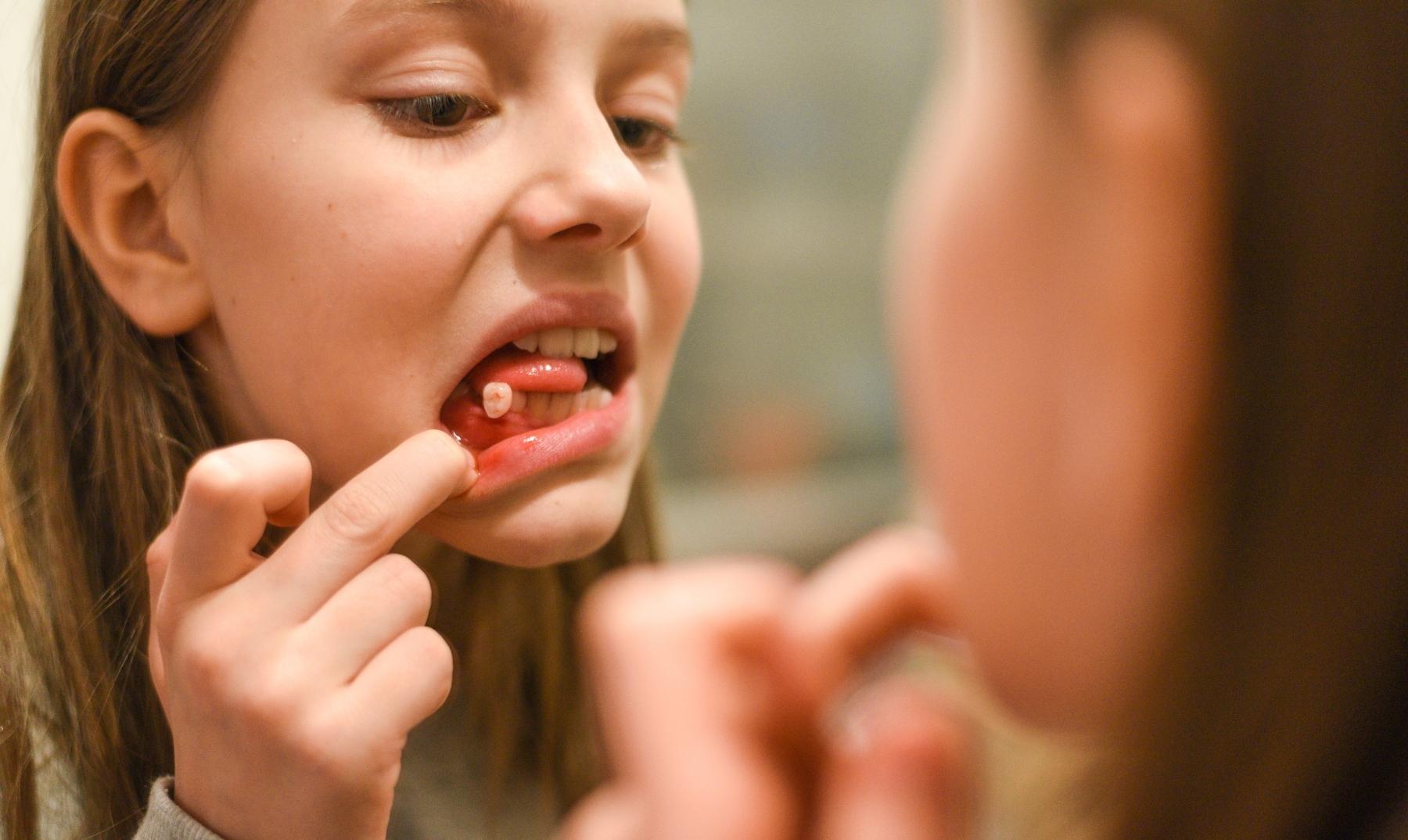 loose teeth