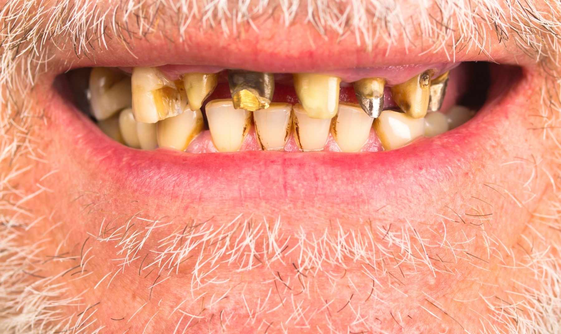 rotten teeth
