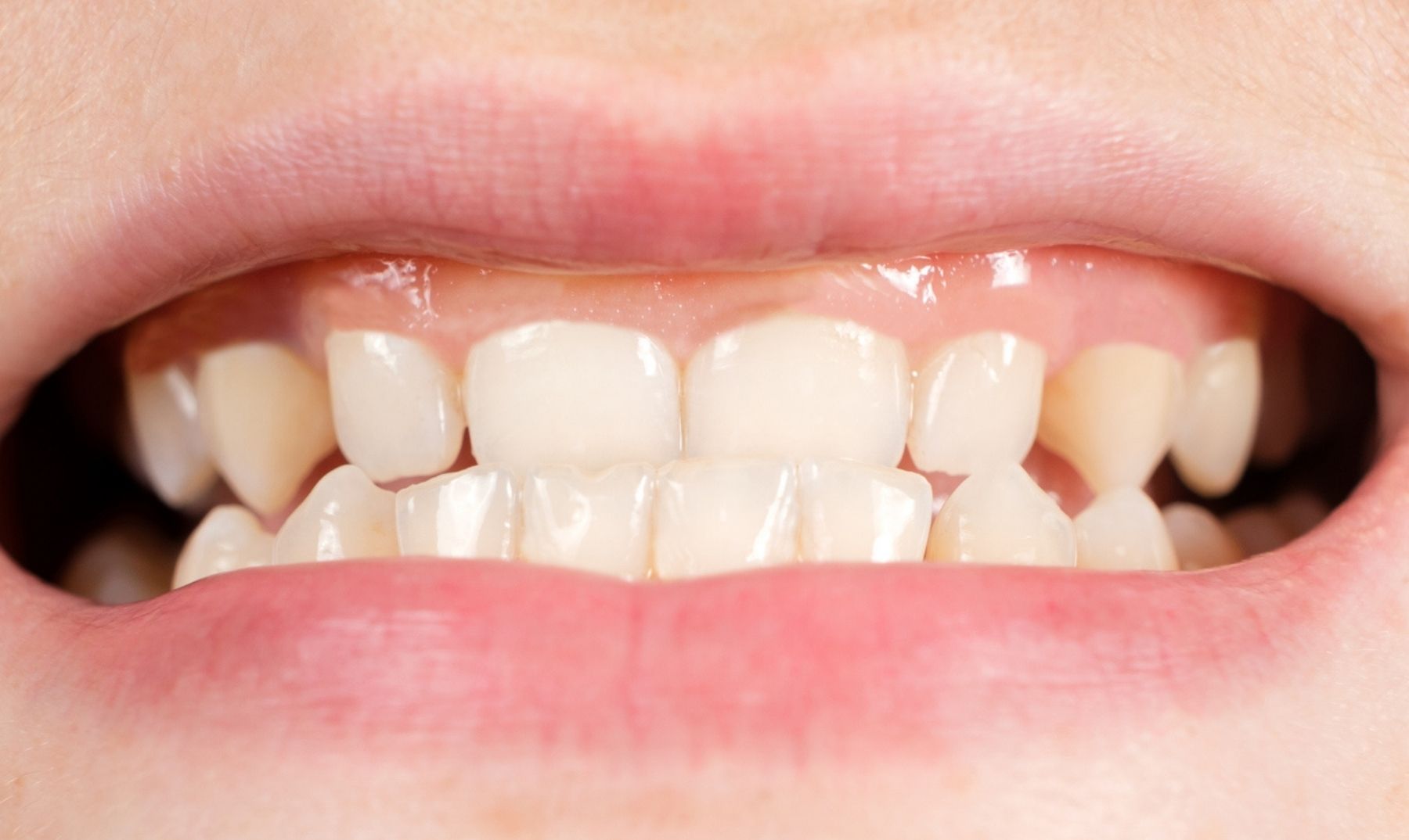 small teeth