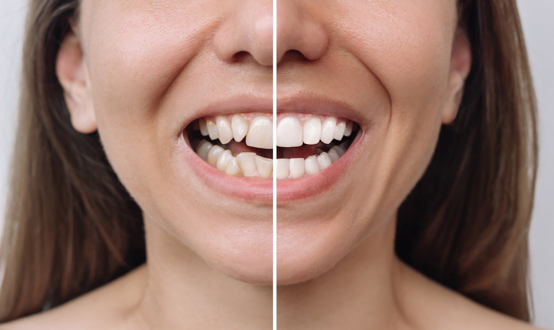 uneven teeth